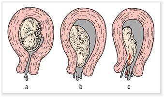 Gambar Abortus Imminens