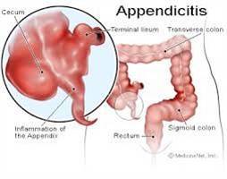 Gambar Apendisitis Akut