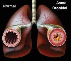 Gambar Asma Bronkial