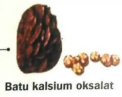Gambar Batu Kalsium