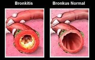 Gambar Bronkitis