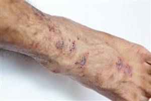 Gambar Dermatitis Stasis