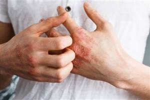 Gambar Dermatitis