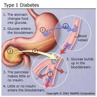 Gambar Diabetes Melitus Tipe 1