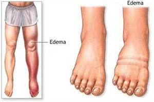 Gambar Edema