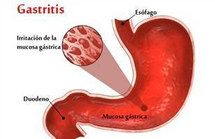 Gambar Gastritis