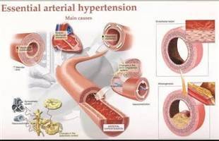 Gambar Hipertensi Primer