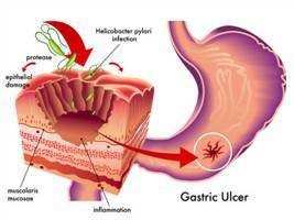 Gambar Perforasi Gastrointestinal
