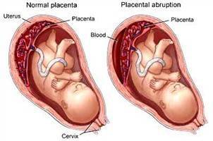 Gambar Solusio Plasenta