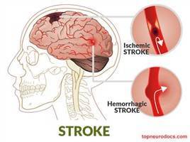 Gambar Stroke