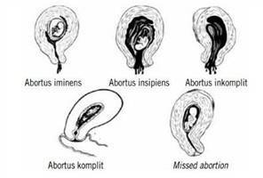 Abortus Definisi Penyebab Jenis Epidemiologi 