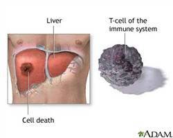 Gambar Abses Hati Fungal