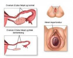 Gambar Amenore Primer