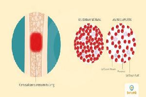 Gambar Anemia Aplastik