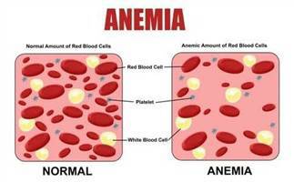 Gambar Anemia Berat