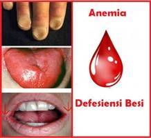 Gambar Anemia Defisiensi Besi