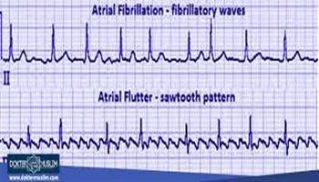 Gambar Atrial Fibrilasi