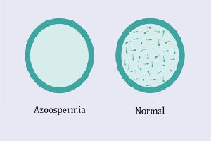 Gambar Azoospermia