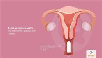 Gambar Benda Asing Vagina