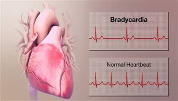 Gambar Bradikardia