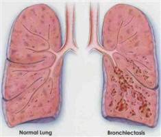 Gambar Bronkiektasis