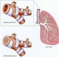 Gambar Bronkitis Akut