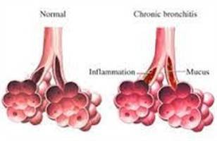 Gambar Bronkitis Kronis