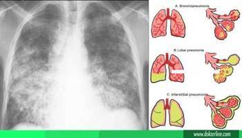 Gambar Bronkopneumonia