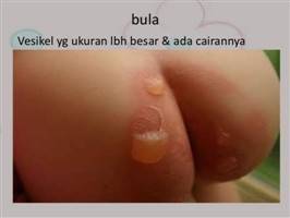 Gambar Bula Epidermal