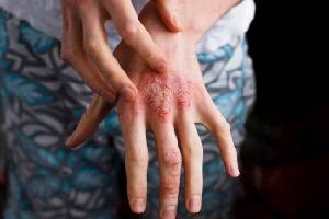 Gambar Dermatitis Akut