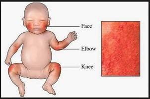 Gambar Dermatitis Atopik