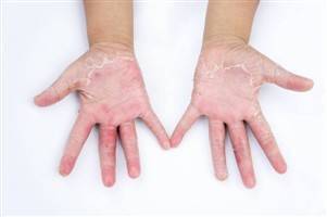 Gambar Dermatitis Kontak Kronis