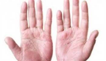 Gambar Dermatitis Kontak Subakut