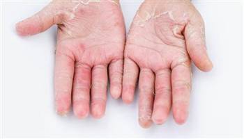 Gambar Dermatitis Kontak