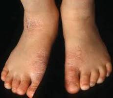 Gambar Dermatitis Kronis