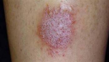 Gambar Dermatitis Numularis