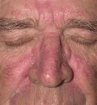 Gambar Dermatitis Seboroik