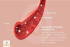 Gambar Disseminated Intravascular Coagulation