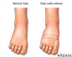 Gambar Edema Lokal