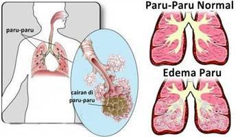 Gambar Edema Paru