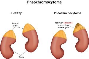 Gambar Feokromositoma