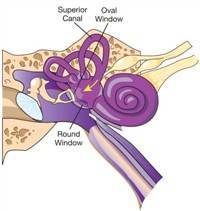 Gambar Fistula Perilymphatic