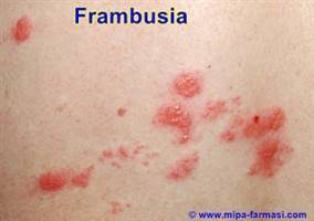 Gambar Frambusia