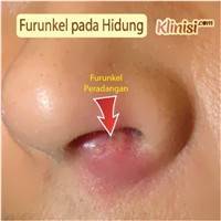 Gambar Furunkel Hidung