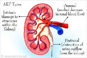 Gambar Gagal Ginjal Akut Pasca Renal