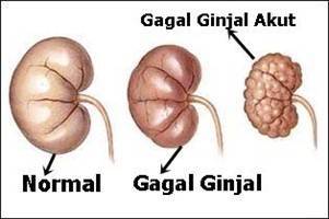 Gambar Gagal Ginjal Akut