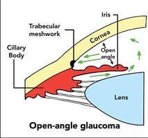 Gambar Glaukoma Sudut Terbuka