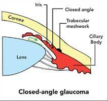 Gambar Glaukoma Sudut Tertutup