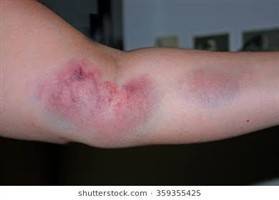 Gambar Hematoma