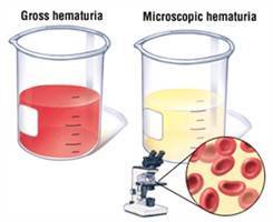 Gambar Hematuria